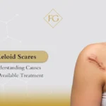Keloid scares