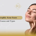 Atrophic acne scars