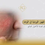 أسباب ظهور الوردية في الوجه