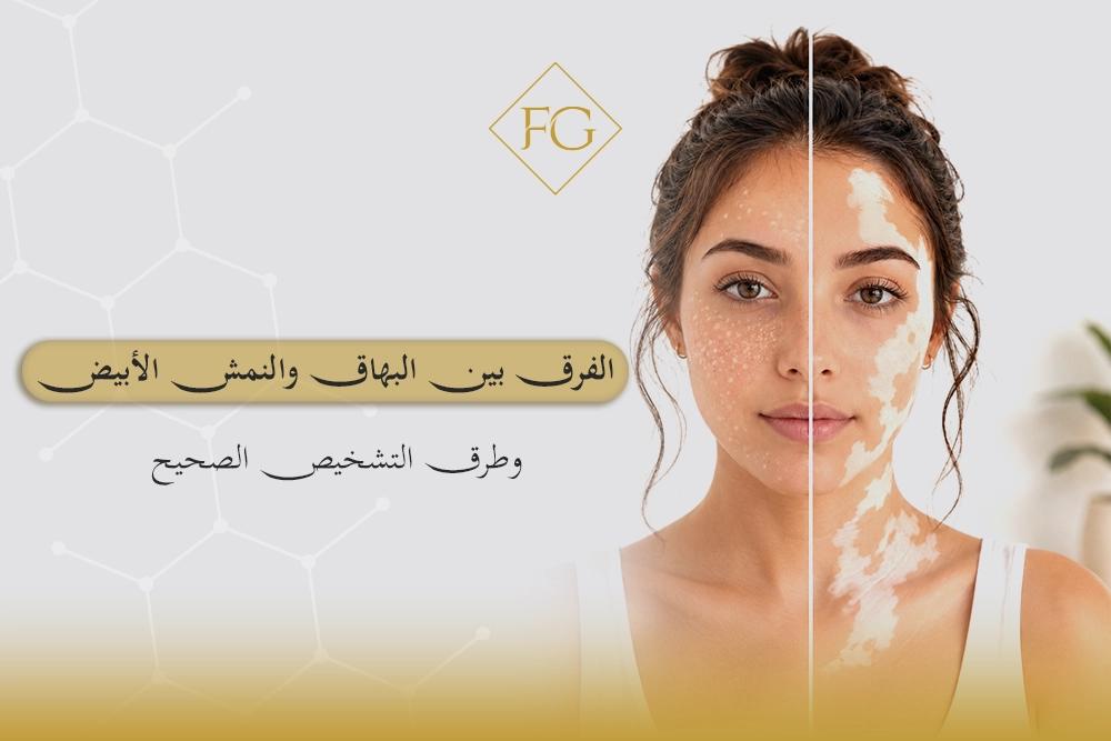 الفرق بين البهاق والنمش الأبيض