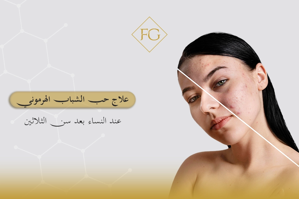 علاج حب الشباب الهرموني