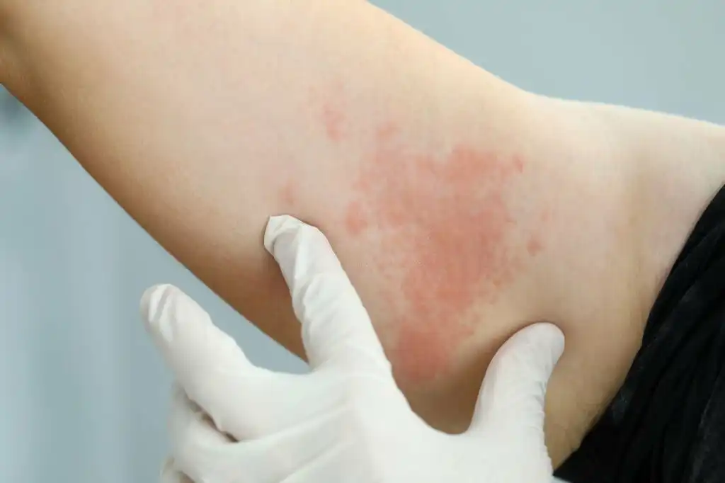 Persistent Skin Rashes or Hives (5)