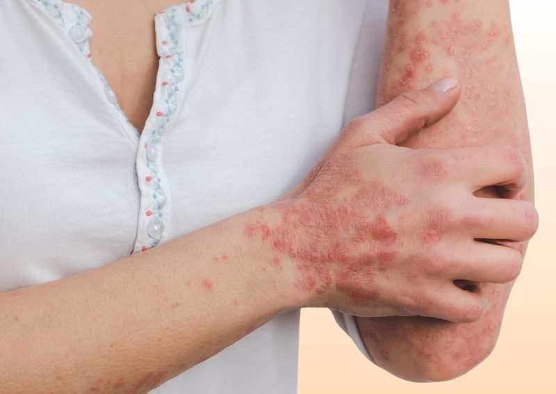 Psoriasis treatment in Dubai by specialist dermatologist