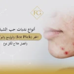 أنواع ندبات حب الشباب