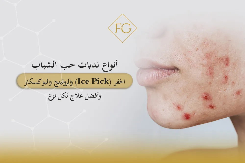 أنواع ندبات حب الشباب