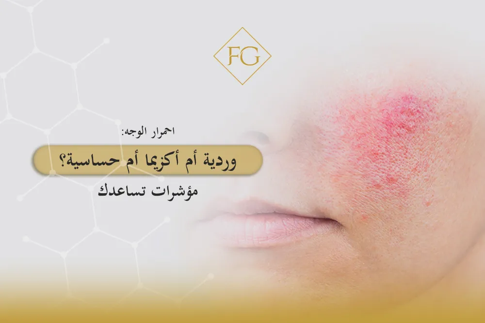 احمرار الوجه