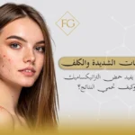 حمض الترانيكساميك للكلف