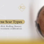 types of acne scars