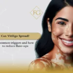 can vitiligo spread
