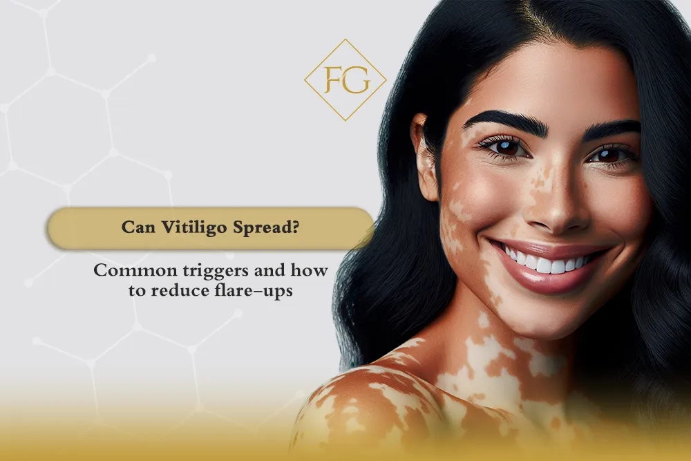 can vitiligo spread