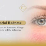 Facial Redness: Rosacea vs Eczema vs Allergy how to tell the difference