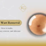laser wart removal aftercare