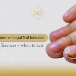 nail psoriasis vs fungal infection