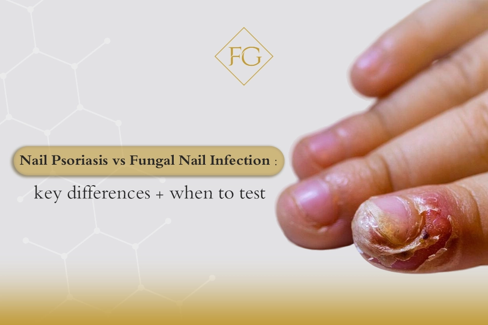 nail psoriasis vs fungal infection