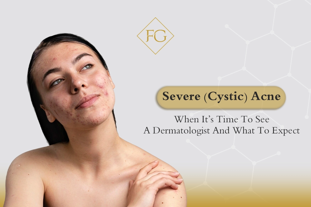 cystic acne treatment options