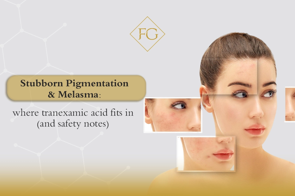 tranexamic acid for melasma