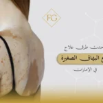 علاج بقع البهاق الصغيرة