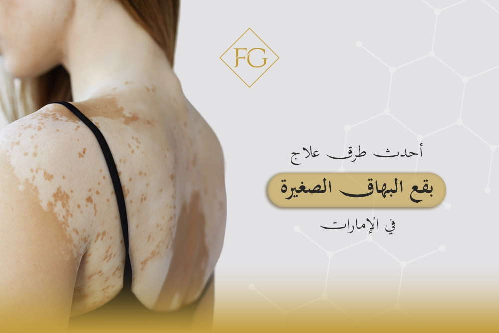 علاج بقع البهاق الصغيرة