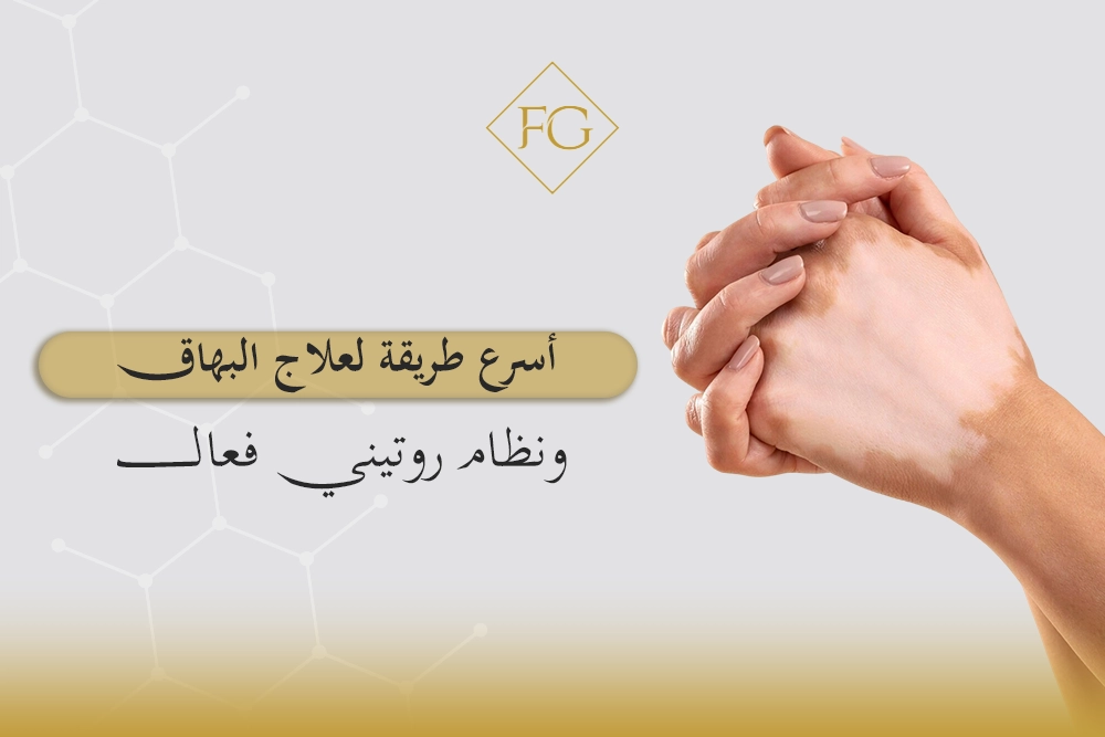 أسرع طريقة لعلاج البهاق