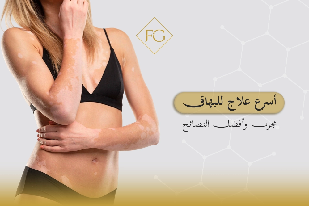 أسرع علاج للبهاق مجرب