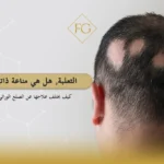 الفرق بين الثعلبة والصلع الوراثي