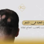 علاج الثعلبة في الشعر عند الرجال