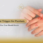 Psoriasis flare up treatment