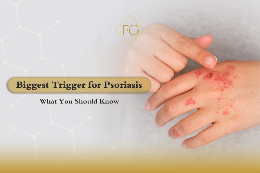 biggest trigger for psoriasis
