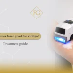 Is excimer laser good for vitiligo?