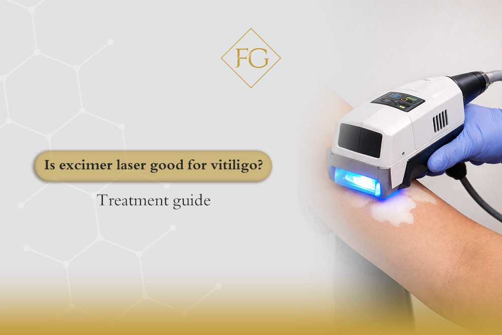 Is excimer laser good for vitiligo?
