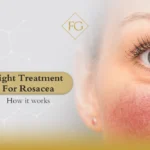 Light treatment for rosacea