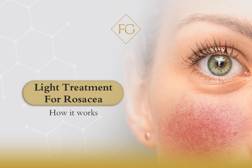 Light treatment for rosacea