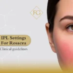IPL settings for rosacea