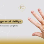 Segmental vitiligo