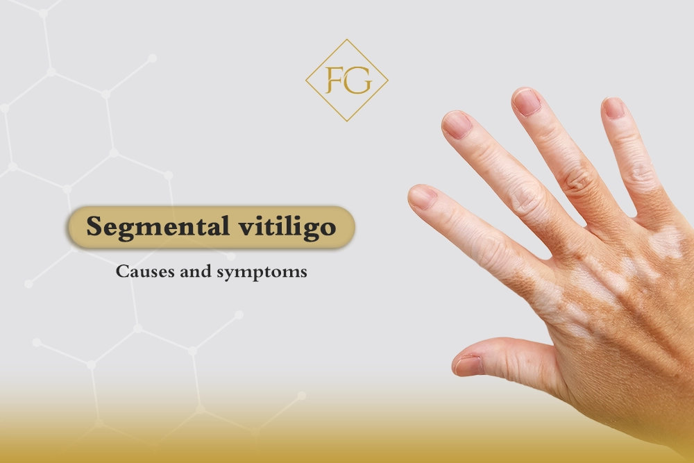 Segmental vitiligo