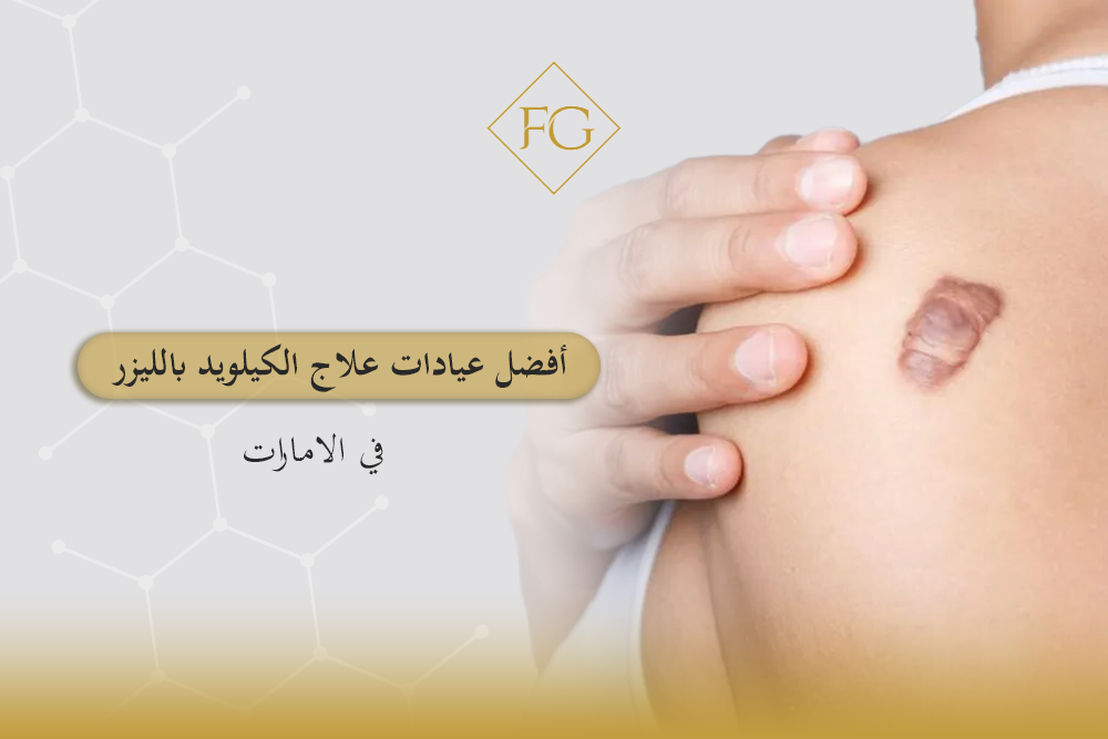 علاج الكيلويد بالليزر