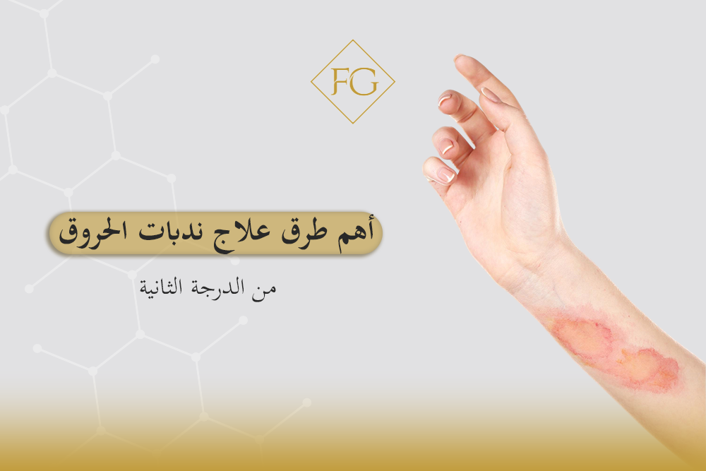 ندبات الحروق من الدرجة الثانية