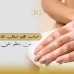 ظهور البهاق المفاجئ