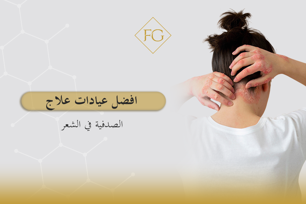 علاج الصدفية في الشعر