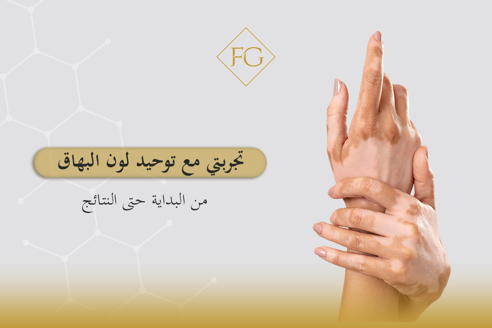 توحيد لون البهاق