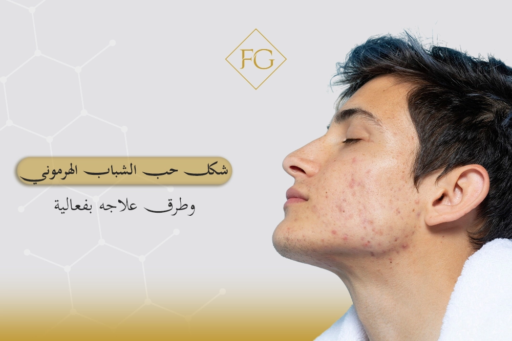 شكل حب الشباب الهرموني