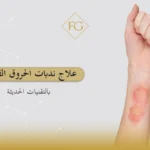 علاج ندبات الحروق القديمة