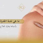 ما هي ندبة الجدرة