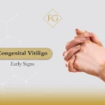 Congenital vitiligo