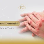 Contact dermatitis