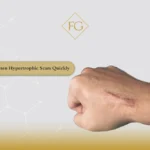 Flatten Hypertrophic Scars