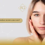 severe acne scars