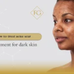 acne scar treatment for dark skin