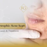 Hypertrophic acne scars