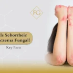 Is Seborrheic Eczema Fungal